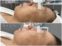 60代 毛穴洗浄&幹細胞