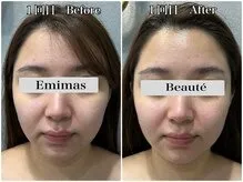 20代後半 小顔矯正&毛穴洗浄