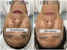 60代前半 毛穴洗浄&幹細胞