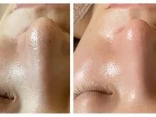 30代前半 毛穴洗浄1回